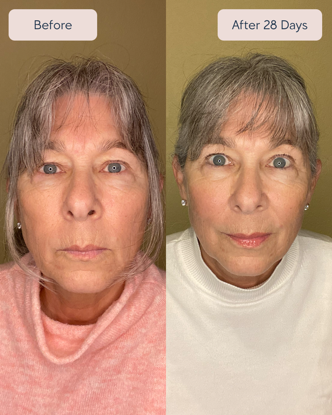 Renewa EyeLift Device