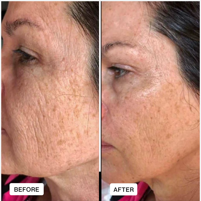 Sterile Needle Heads