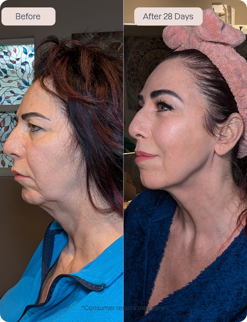 RenewaLift Device + Renewa AgeDefy Serum