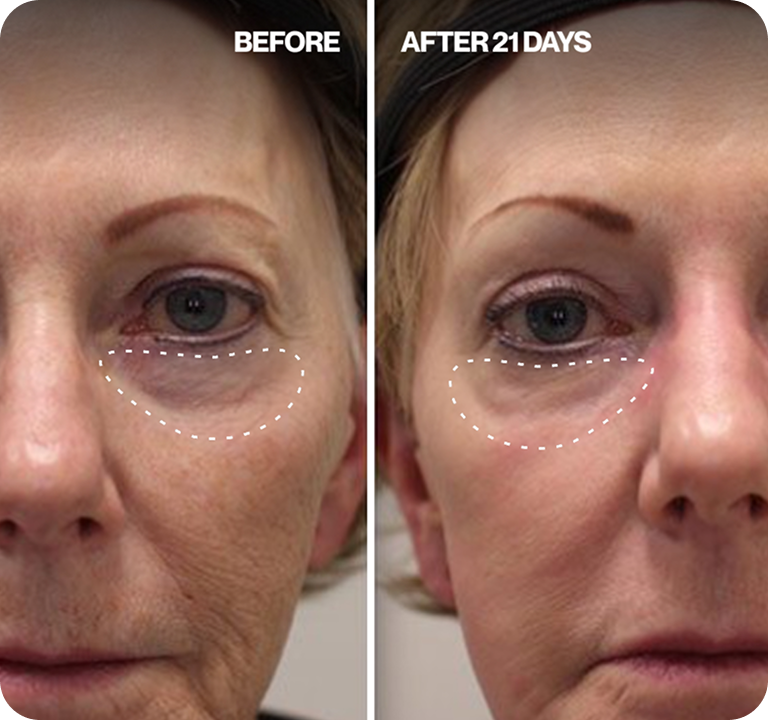 Renewa EyeLift™ Device