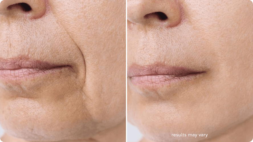 Fine Lines before and after RenewaLift result
