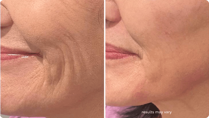 Smooth Wrinkles before and after RenewaLift result