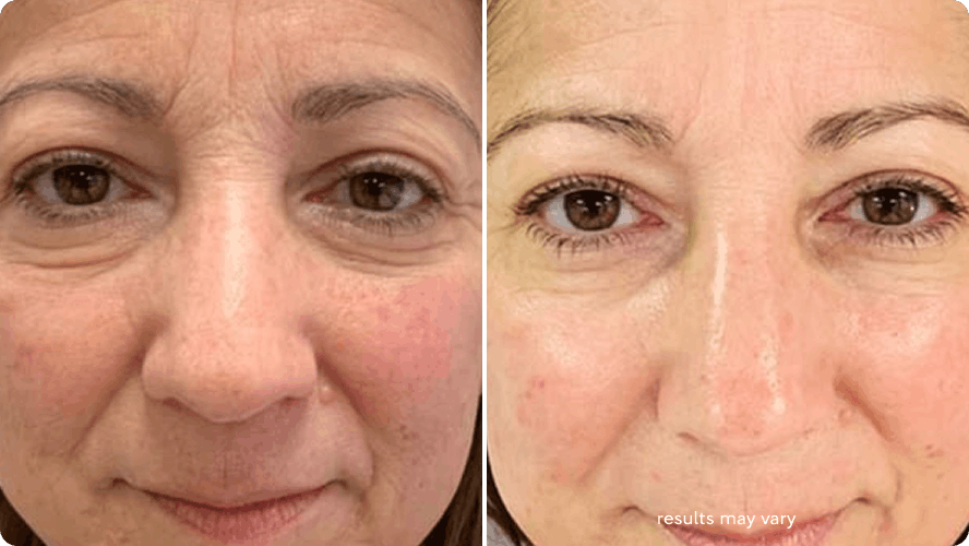 Loss of Firmness before and after RenewaLift result