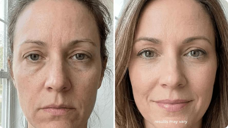 Dry Sagging-Looking Skin before and after RenewaLift result