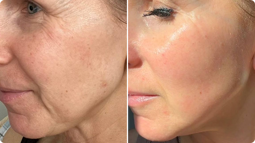 Dull, Tired-Looking Skin before and after RenewaLift result