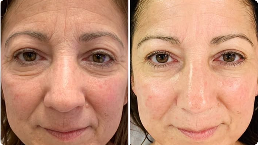 Uneven-Looking Tone and Texture before and after RenewaLift result