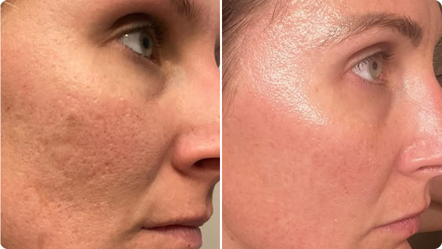 Dry, Rough-Feeling Skin before and after RenewaLift result