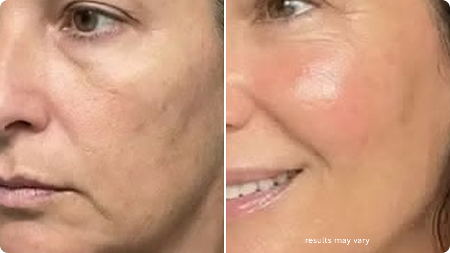 Dull Tired-Looking Skin before and after RenewaLift result
