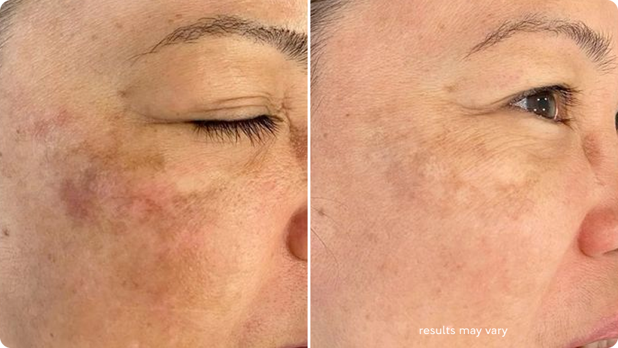 Uneven Tone & Texture before and after RenewaLift result