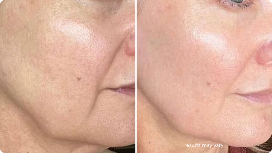 Lack of Radiance before and after RenewaLift result