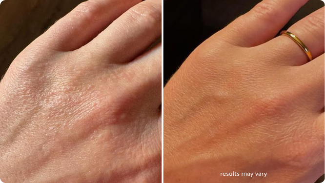 Dry & Dull Hands before and after RenewaLift result