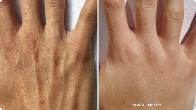 Visible Lines & Crepey Skin before and after RenewaLift result