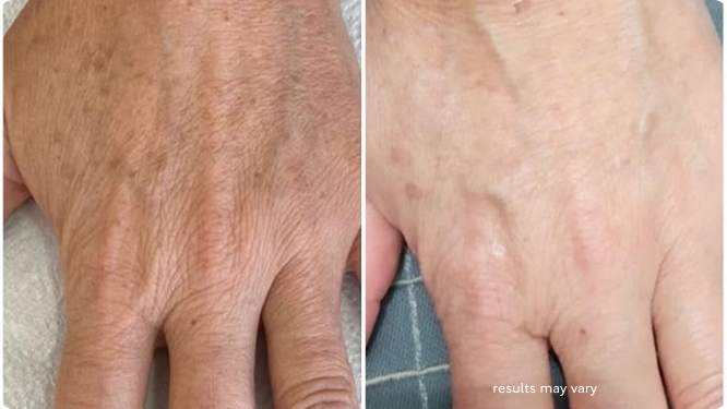 Age Spots & Uneven Tone before and after RenewaLift result
