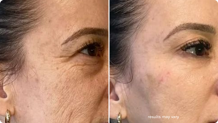 Crow’s Feet before and after RenewaLift result