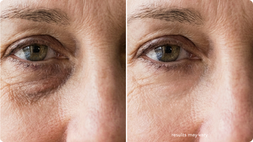 Dark Circles before and after RenewaLift result