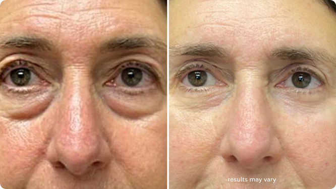 Puffiness before and after RenewaLift result
