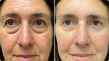Under-Eye Bags before and after RenewaLift result