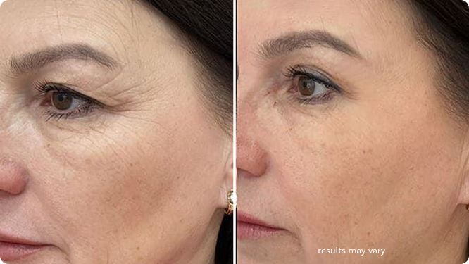 Fine Lines & Crow’s Feet before and after RenewaLift result