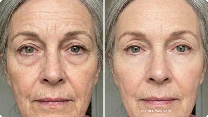Crepey Under-Eye Skin before and after RenewaLift result