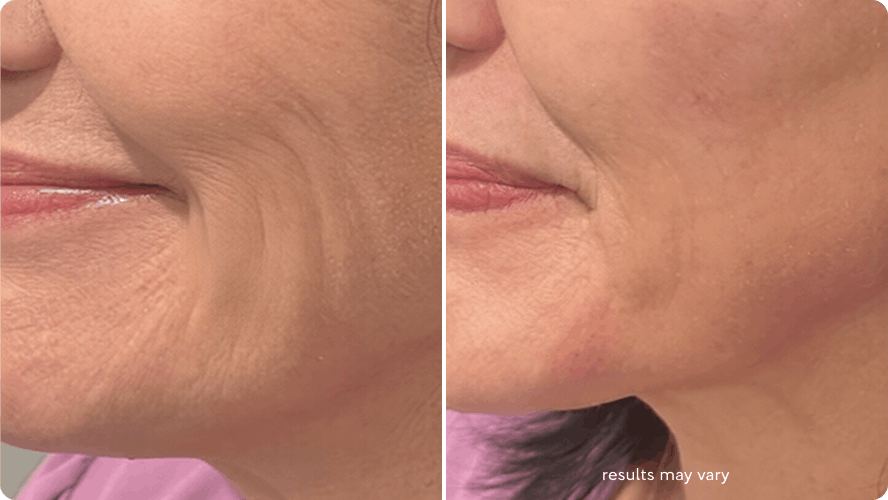 Mouth lines before and after RenewaLift result
