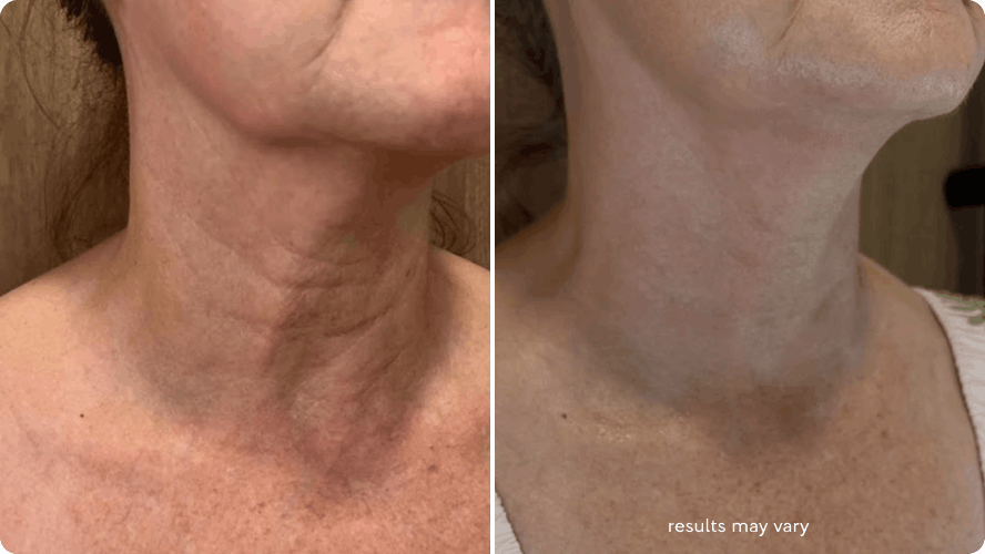 Neck Saggy skin before and after RenewaLift result