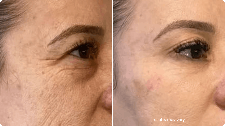 Under eye wrinkles before and after RenewaLift result
