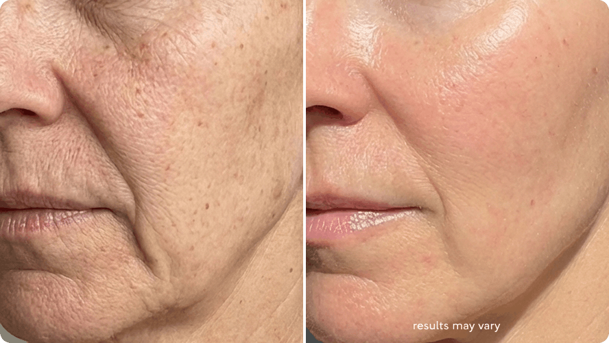 Dry, Tight-Feeling Skin before and after RenewaLift result