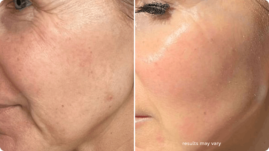 Fine Lines and Uneven Texture before and after RenewaLift result
