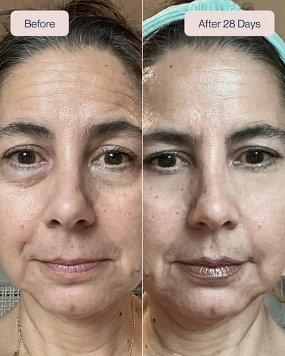 Renewa EyeLift Device