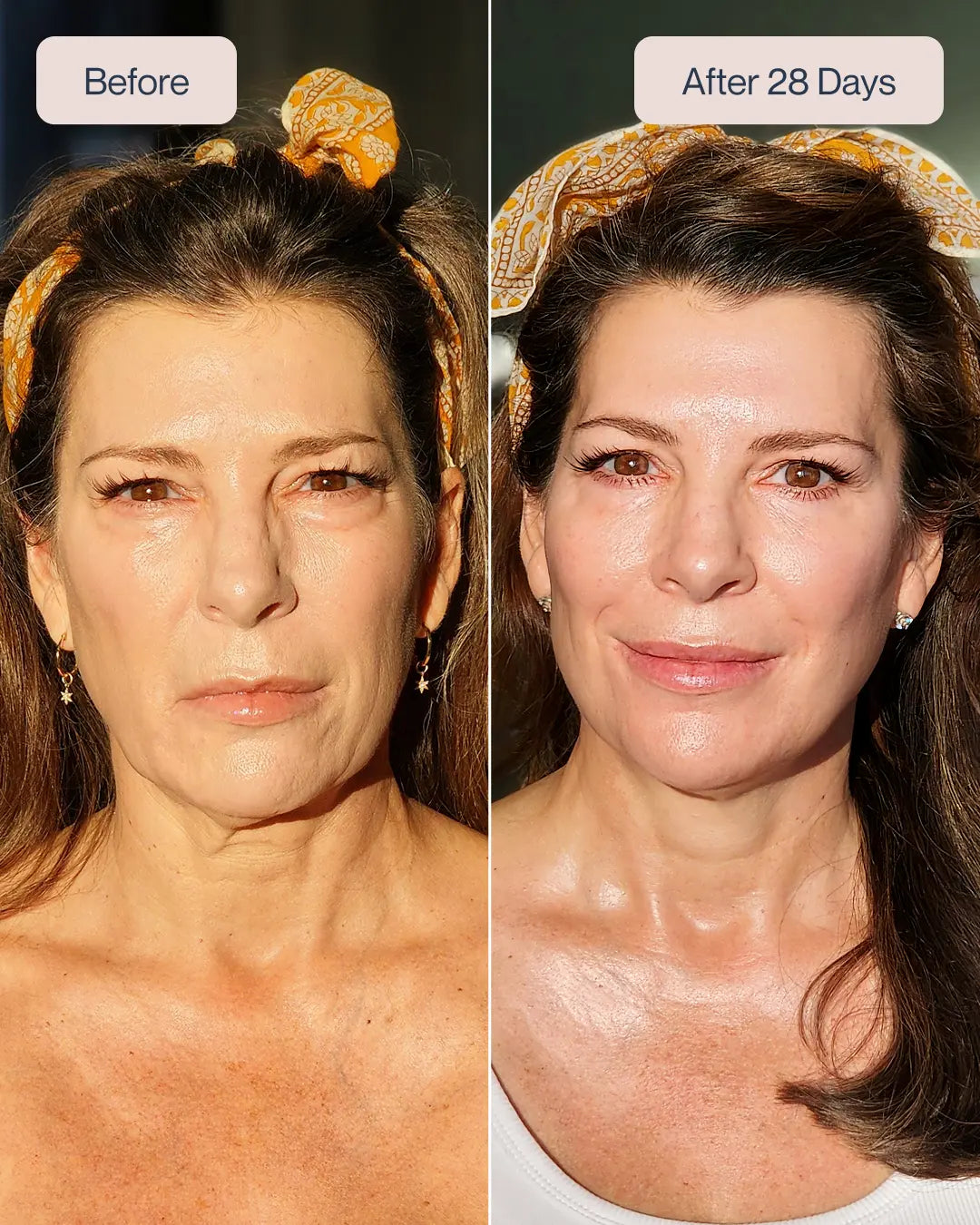 Renewa EyeLift Device