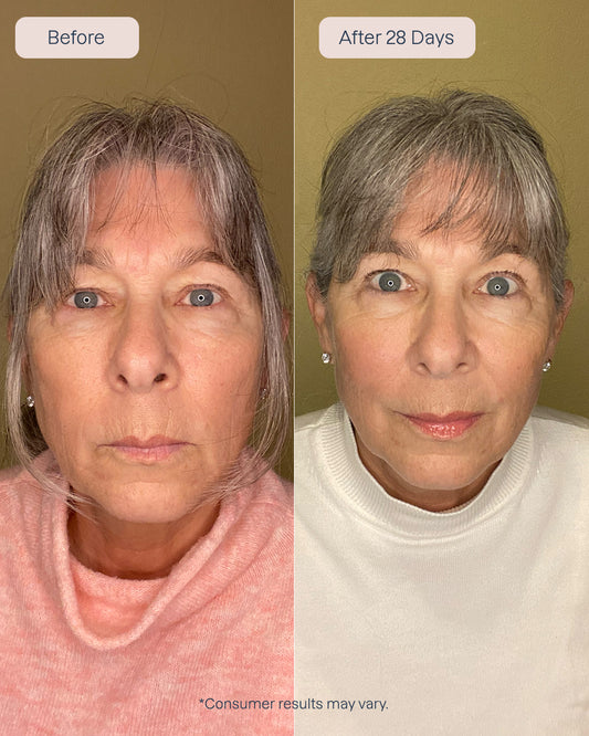 Renewa EyeLift Device