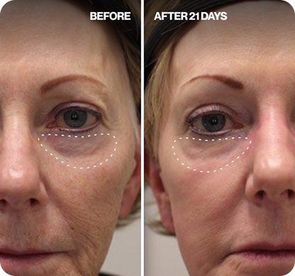 Renewa EyeLift™ Device
