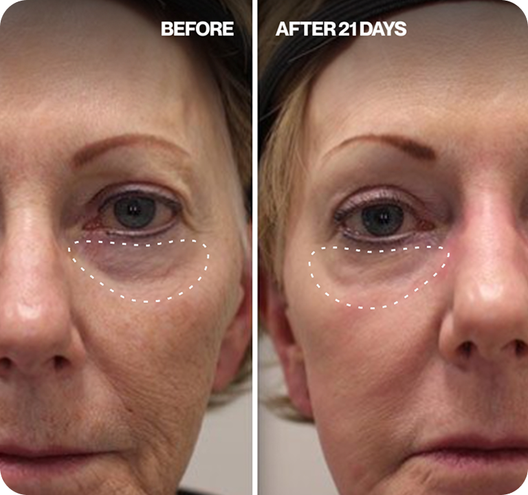 Renewa Eyelift